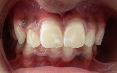case-1-teeth-before