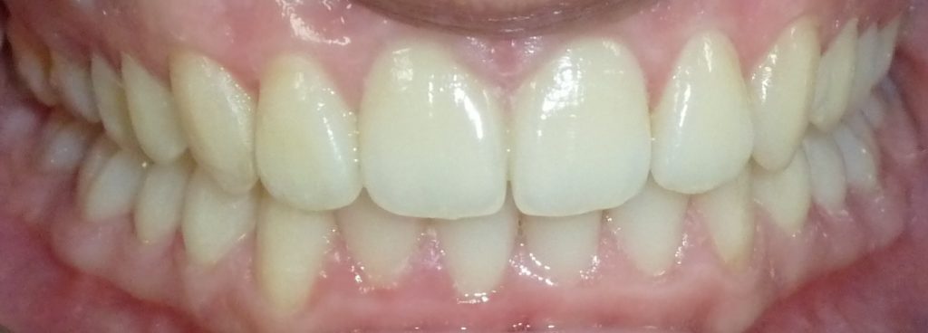 Invisalign After 1