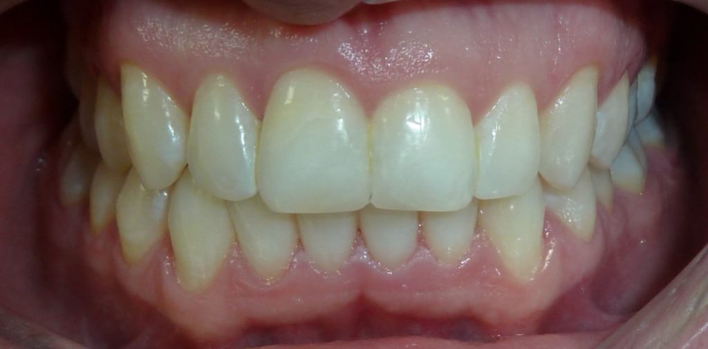 Invisalign After 2